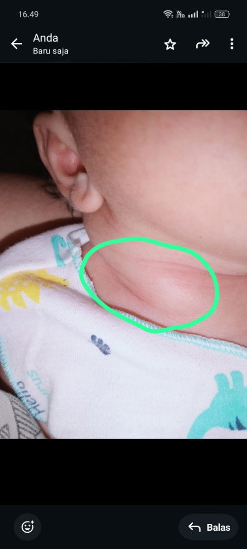 Leher sebelah bengkak