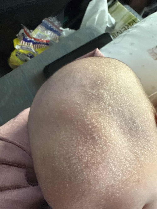 Ruam di kepala dan dahi newborn