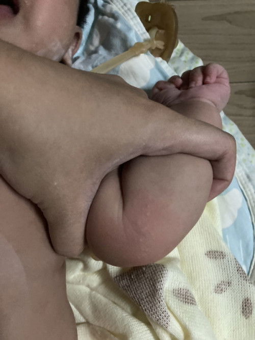 ลูกมีผื่นขึ้นแบบนี้ตามตัวอันตรายไหมคะ