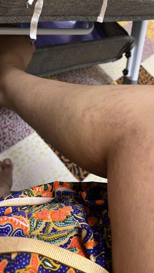 SAYA ALLERGIC KE ?