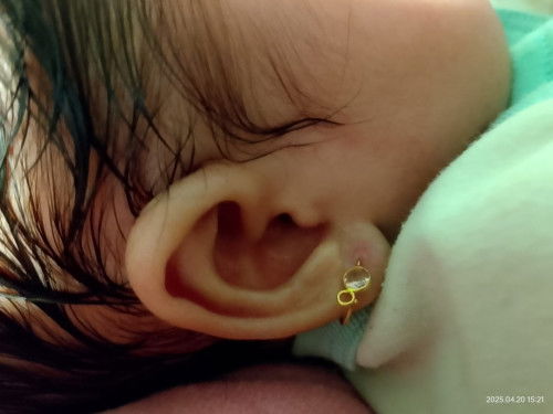 Bekas tindikan anting pada bayi