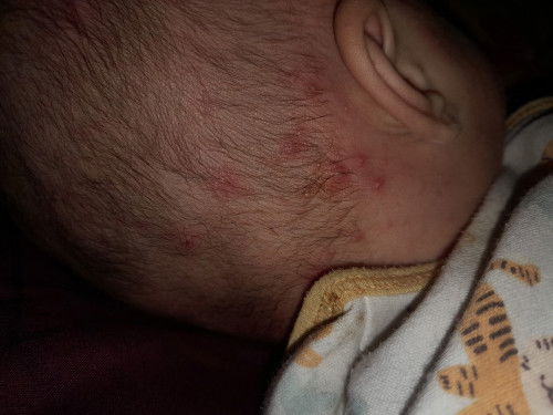 Bun bintik merah kayak bisul kecil2 itu knp ya