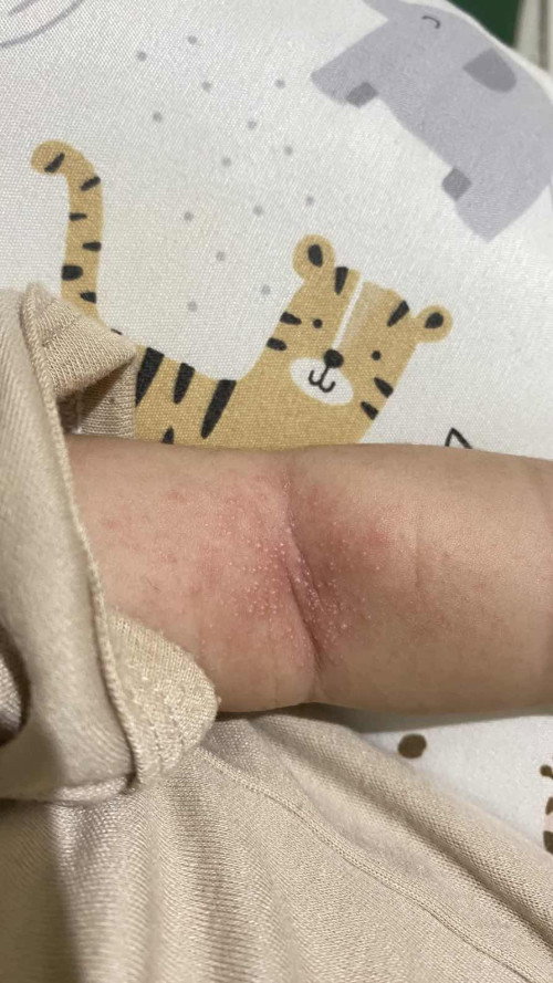 Beruntusan di lipatan lengan