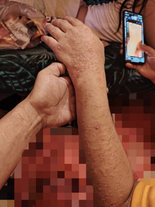 Rashes (25 Weeks)