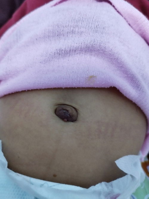 Apakah ini tidak apa apa jika pusar bayi seperti ini?