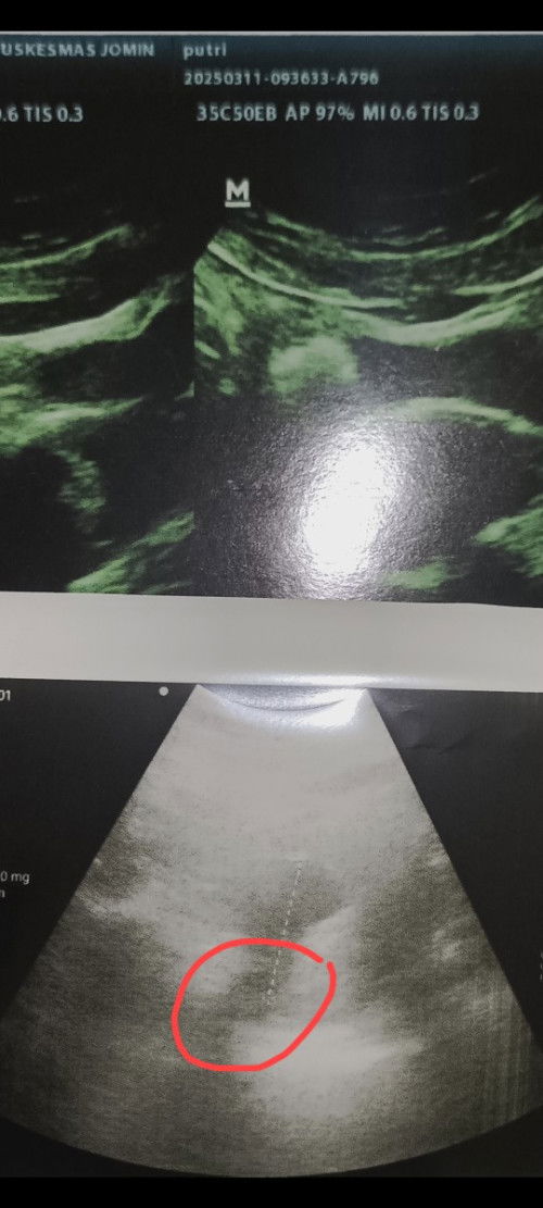 USG beberapa minggu yang lalu