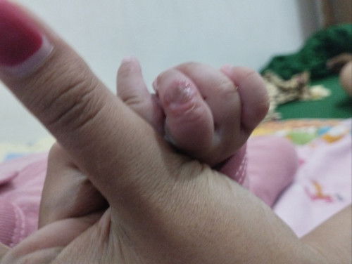 Luka lepuh pada bayi