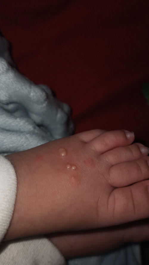 bentol putih seperti jerawat