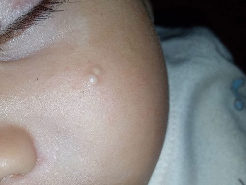 Bintik di pipi bayi