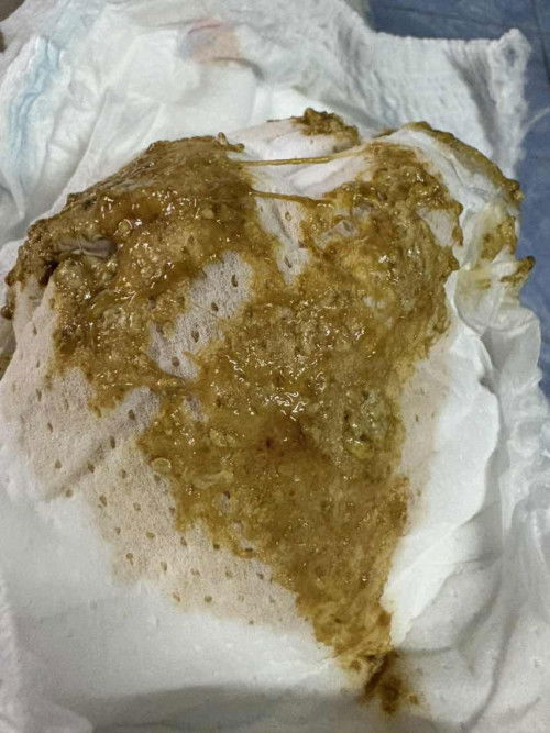 ถ่ายมีมูกเลือดปน