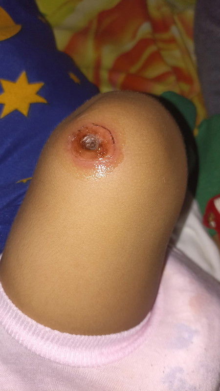 Luka pada bayi 5bln, melenting dan melebar solusinya dong bunda?