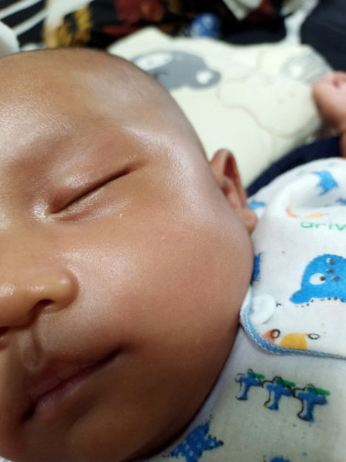 Jerawat bayi tapi gak ilang"