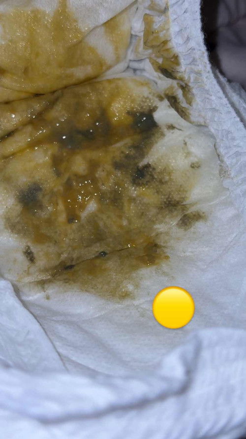 อยากสอบถามแม่ๆ แบบนี้ผิดปกติไหมคะ