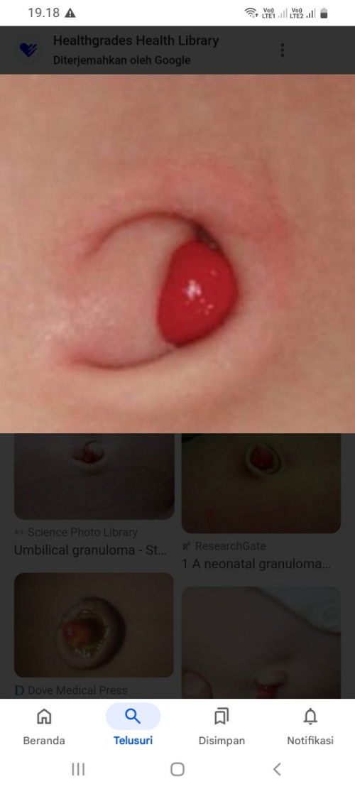 Granuloma umbilikalis