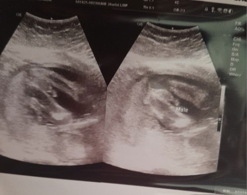 Hello mga mii.. sure npo kaya ito baby boy? Ika 26weeks po gnwa ang ultrasound.