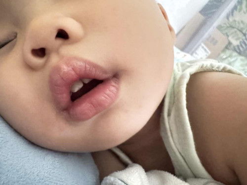ฟันลูก 1 ขวบ เป็นสีขาวขุ่นตรงปลาย