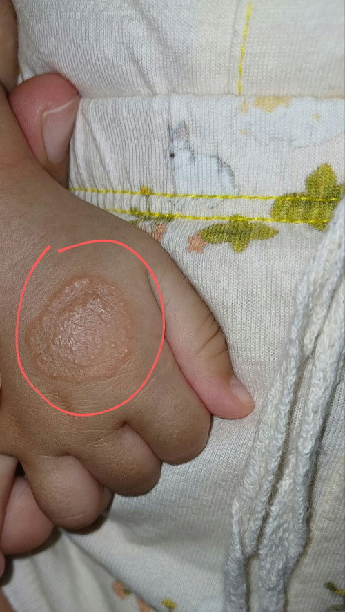 assalamualaikum
bunda mau tanya bayi umur 3bulan di tangan nya ada seperti bruntusan juga engga