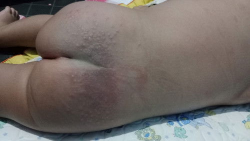 ruam atau alergi
