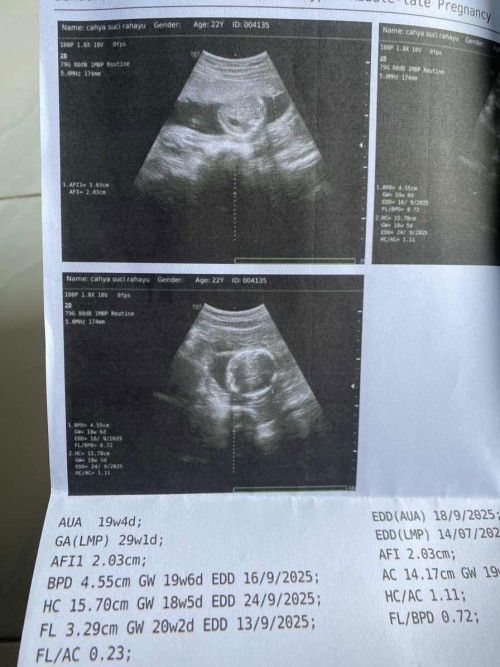 Usia kandungan 19w4d
