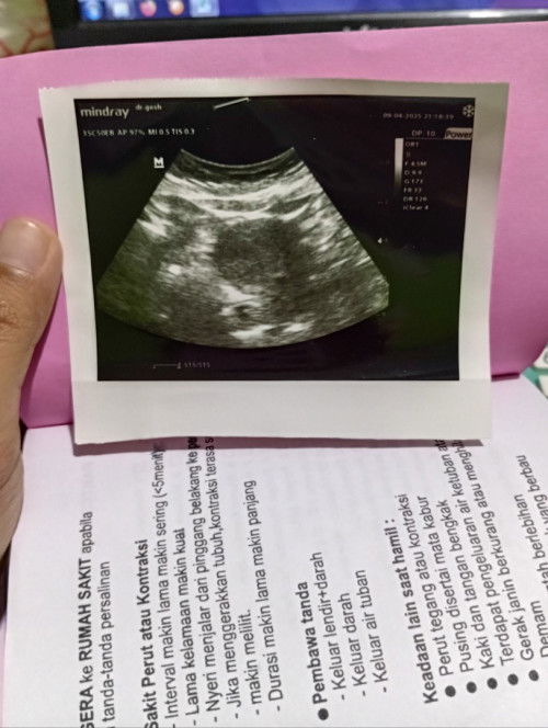 Usg awal bulan usia masi 5/6w
