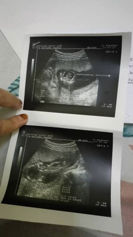Pericardial effusion