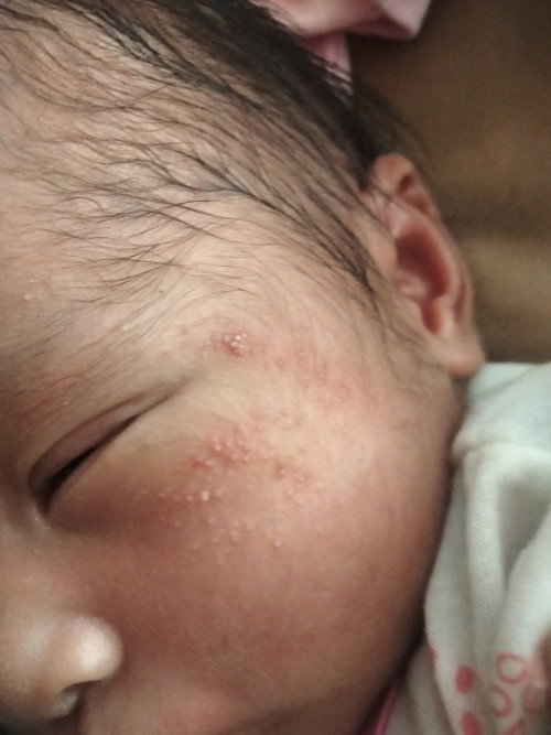 bintik merah pada muka bayi