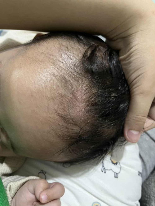 Kulit kepala baby