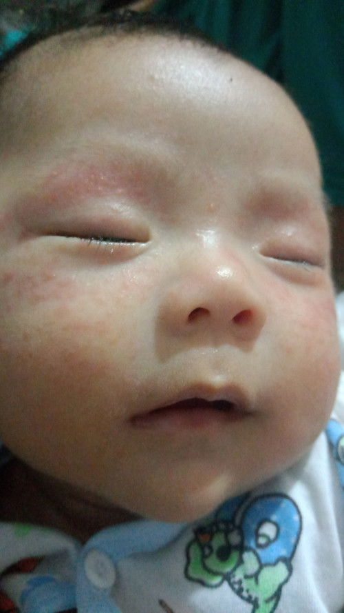 Bund itu ruam yhh hrus pke cream ap lgi yhh