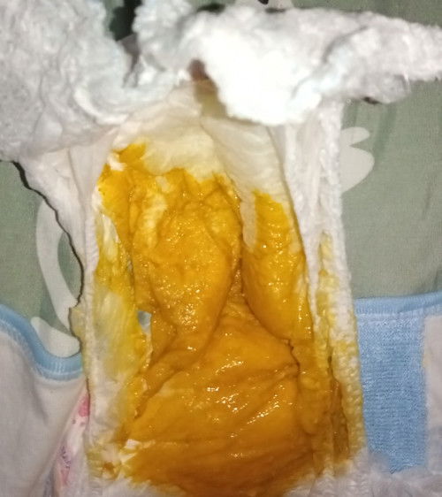 Maaf jijik bun mau nanya klo bab kek gini normal apa diare ya?
Anakku ASI bayi usia 4bln lebih