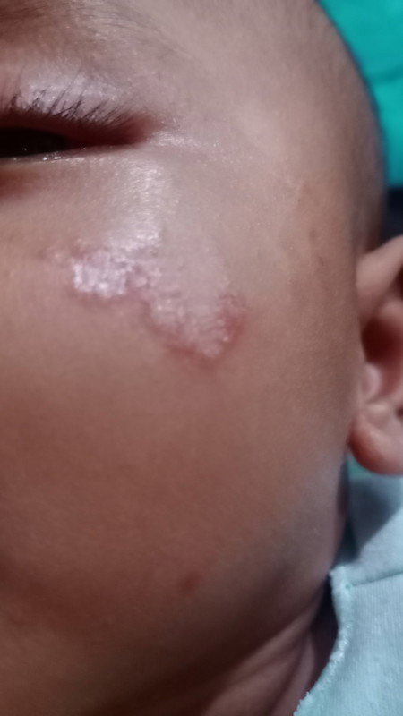 Cara hilangkan ruam merah di pipi dan dagu pakai apa?