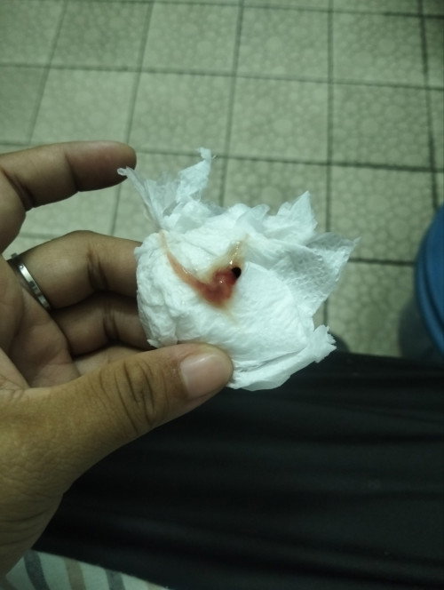 36W มีตกขาวปนมูกเลือดออกมา แต่ไม่มีอาการอื่นร่วมด้วย