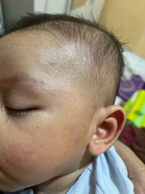 Intoleran susu sapi bayi 4 bulan