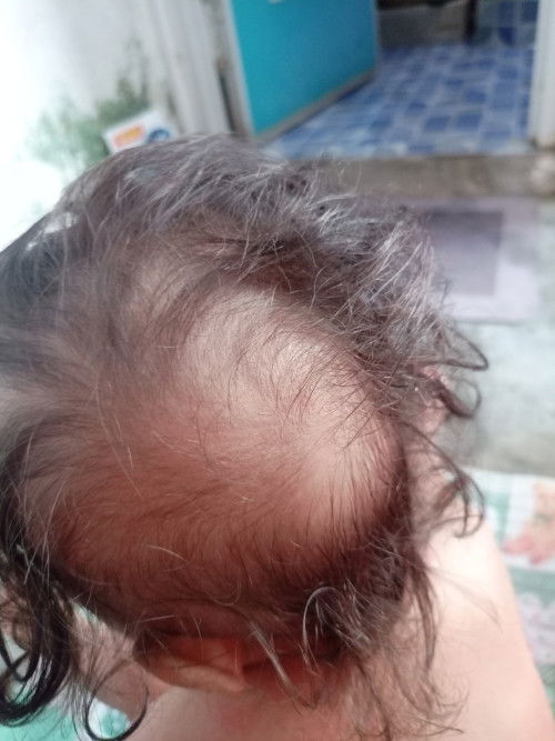 Bayi 13 bulan rambut rontok