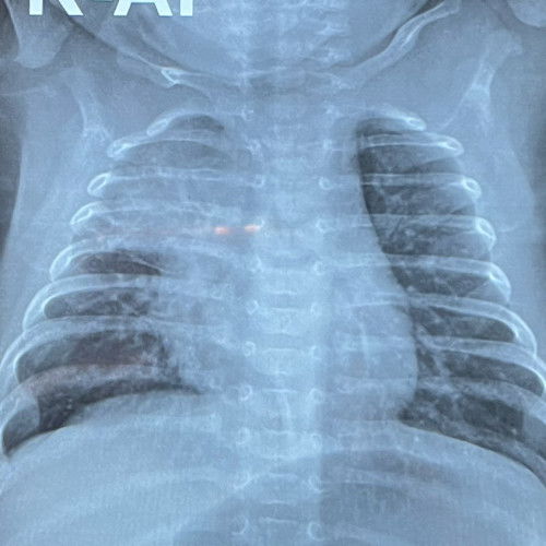 Pengalaman broncopneumonia