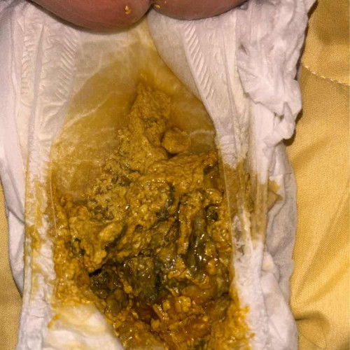 น้อง4เดือนอึมาหลายวัน