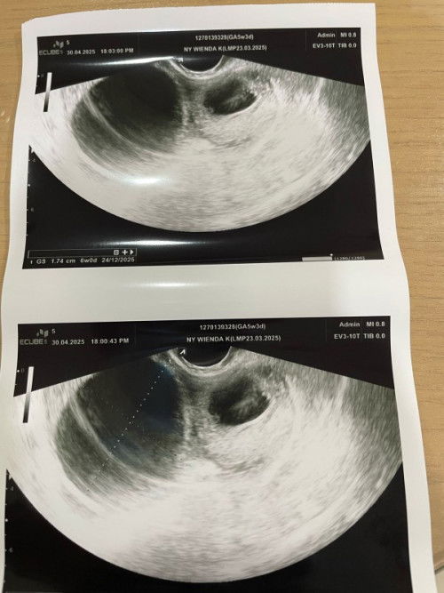Kista saat hamil 5 minggu dan pendarahan terus apa aman untuk kandunhan.. Perlu pencerahan moms