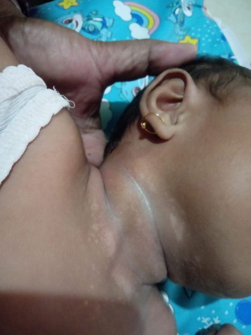 Belang pada leher bayi