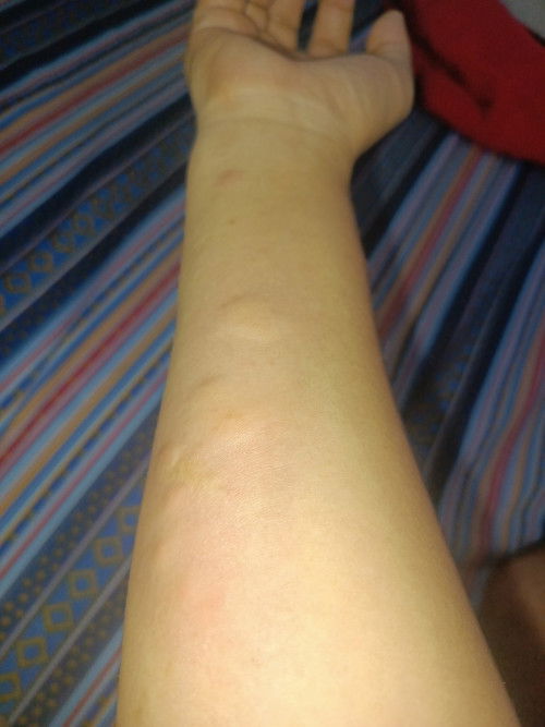 Na experience nyo rin po ba ang sobrang pangangati na kapag kinamot mo ay namamantal?