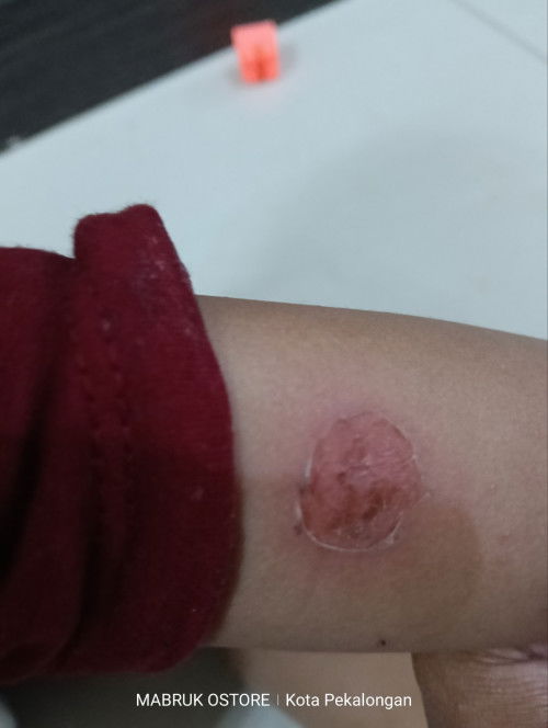 BENTOL AIR LALU SEPERTI MELEPUH