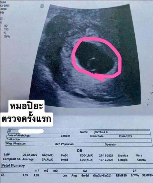 แท้งครบไปเมื่อวันที่ 30 เมษายน2568