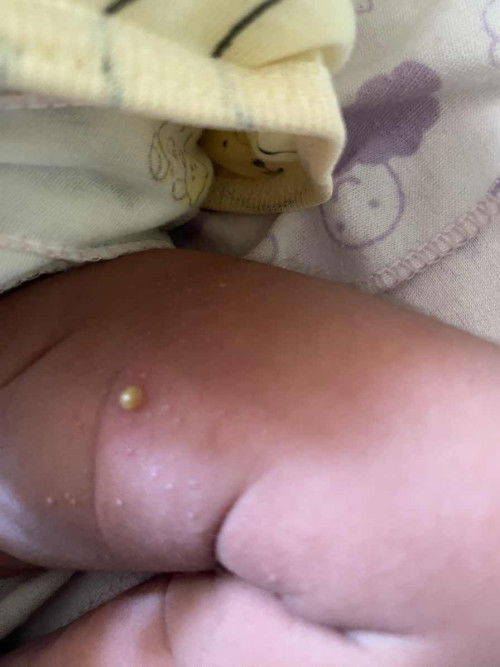 Bintik merah pada bayi