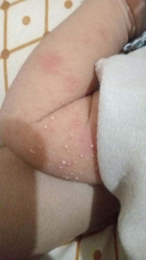 Bintik dan ruam pada newborn