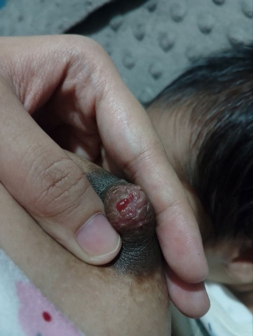 Nipple pain