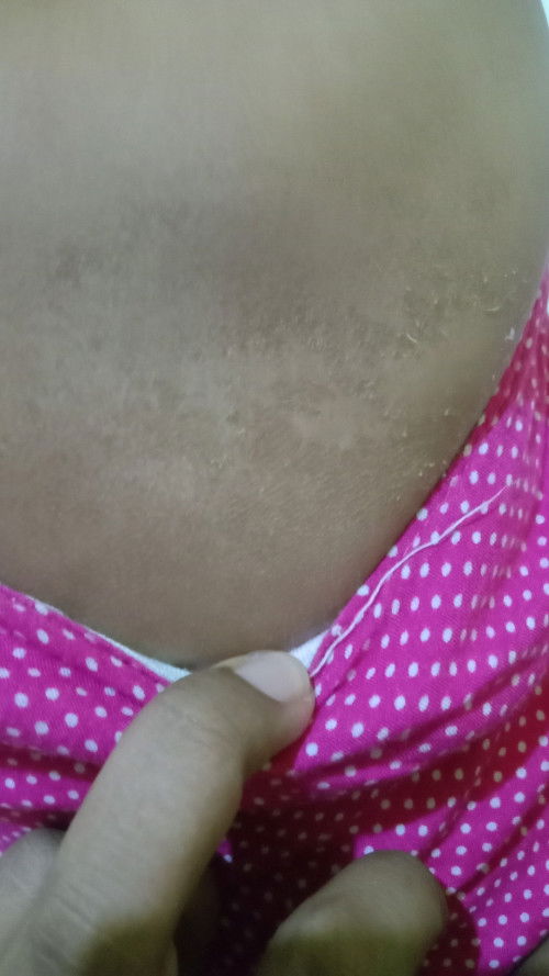 Kulit kering dan ganti kulit