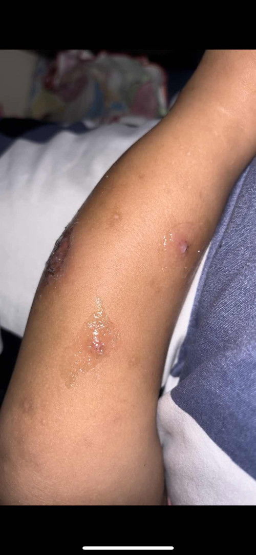 apa kena herpes?