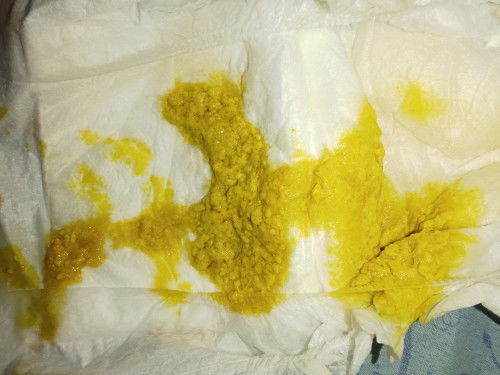 Normal kah bayi 1 bulan bab sehari hampir 7x ,di kasih susu formula ,
Tekstur bab nya seperti itu