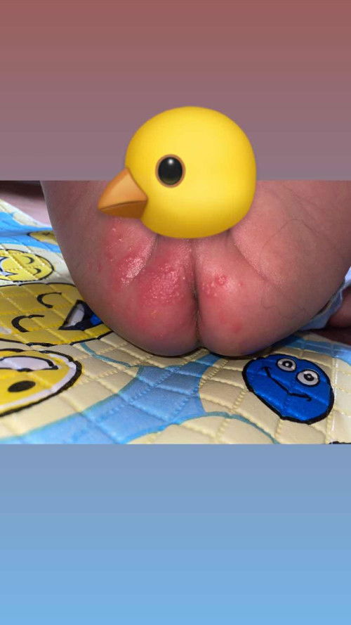 ruam popok pada bayi 2 minggu