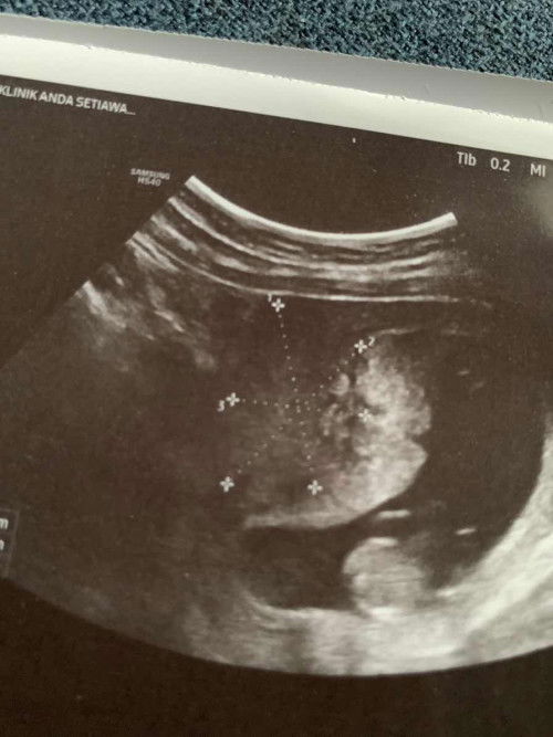 Uri besar ada fibroid ke?