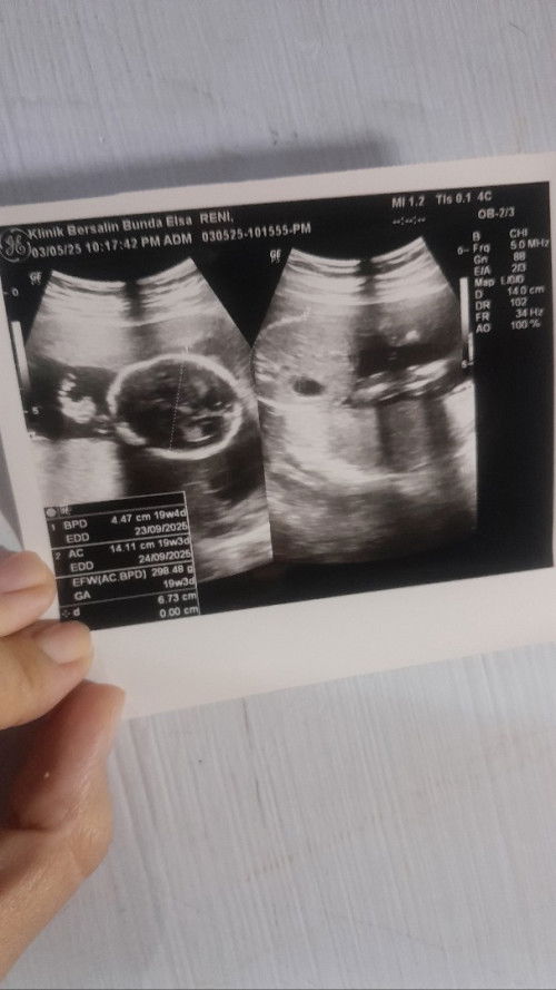 Usia kehamilan 5 bulan ,plasentaku ada d bawah, semoga bisa geser dan g menutup jalan lahir