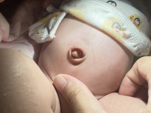 สะดือหลุดวันแรกแบบนี้ปกติไหมคะ